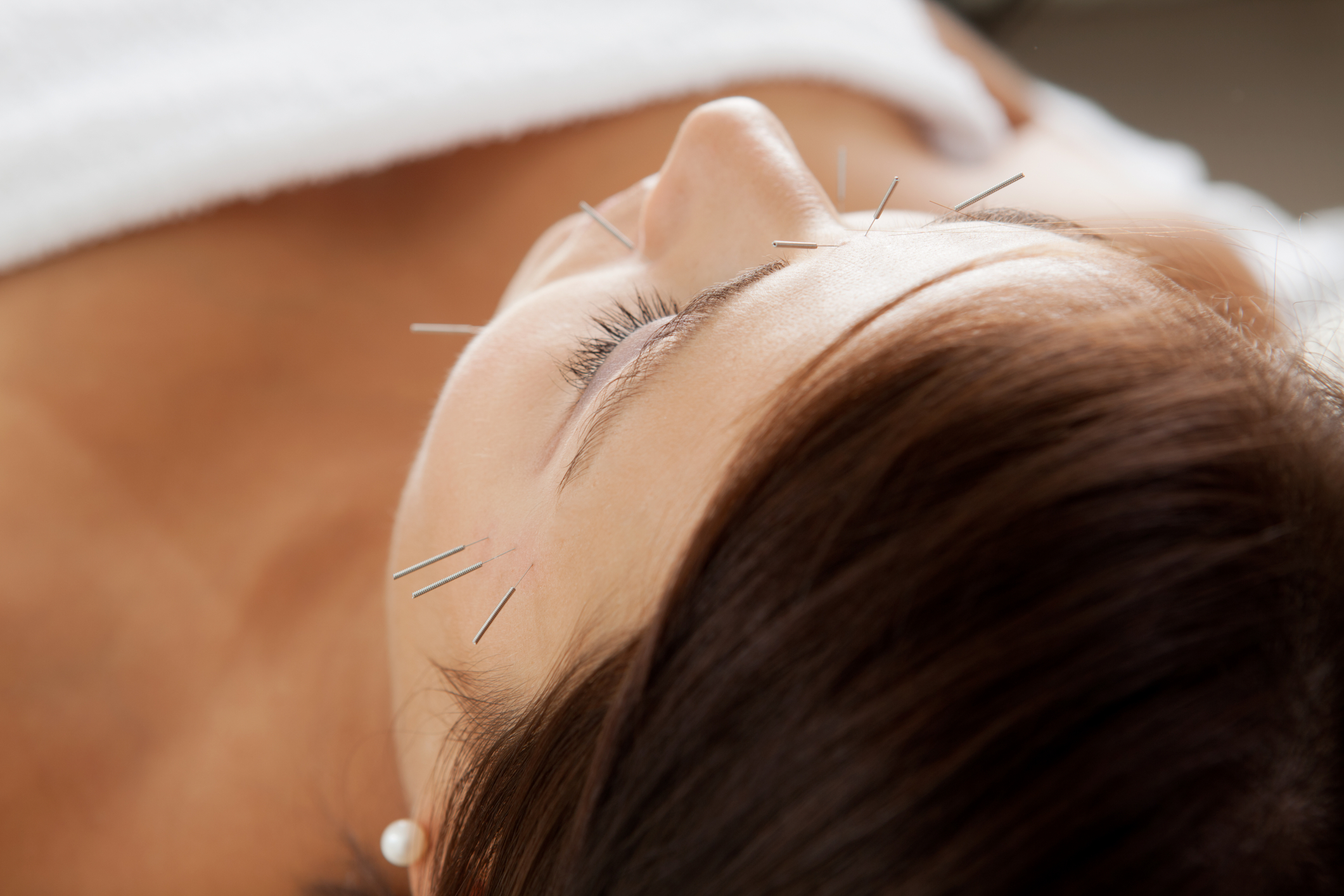 vStore Feature image Access Acupuncture Cosmetic Treatment